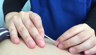 刺さない鍼「無痛のはり」で筋肉の緊張をやさしく整える鍼灸施術の様子